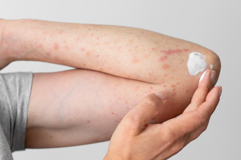Is Homeopathy the Answer for Psoriasis Sufferers?